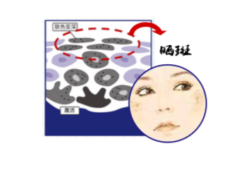 紫外线长期照射导致黑色细胞聚集，从而形成晒斑.png