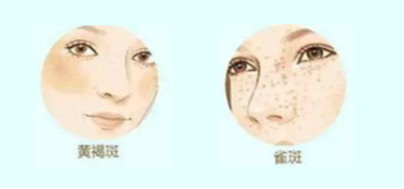 雀斑与黄褐斑等色斑会因紫外线的的照射而加剧.png